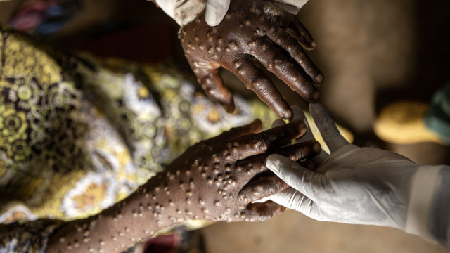 African Union: the Mpox epidemic is not under control